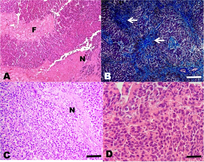 hepatocellular carcinoma histology